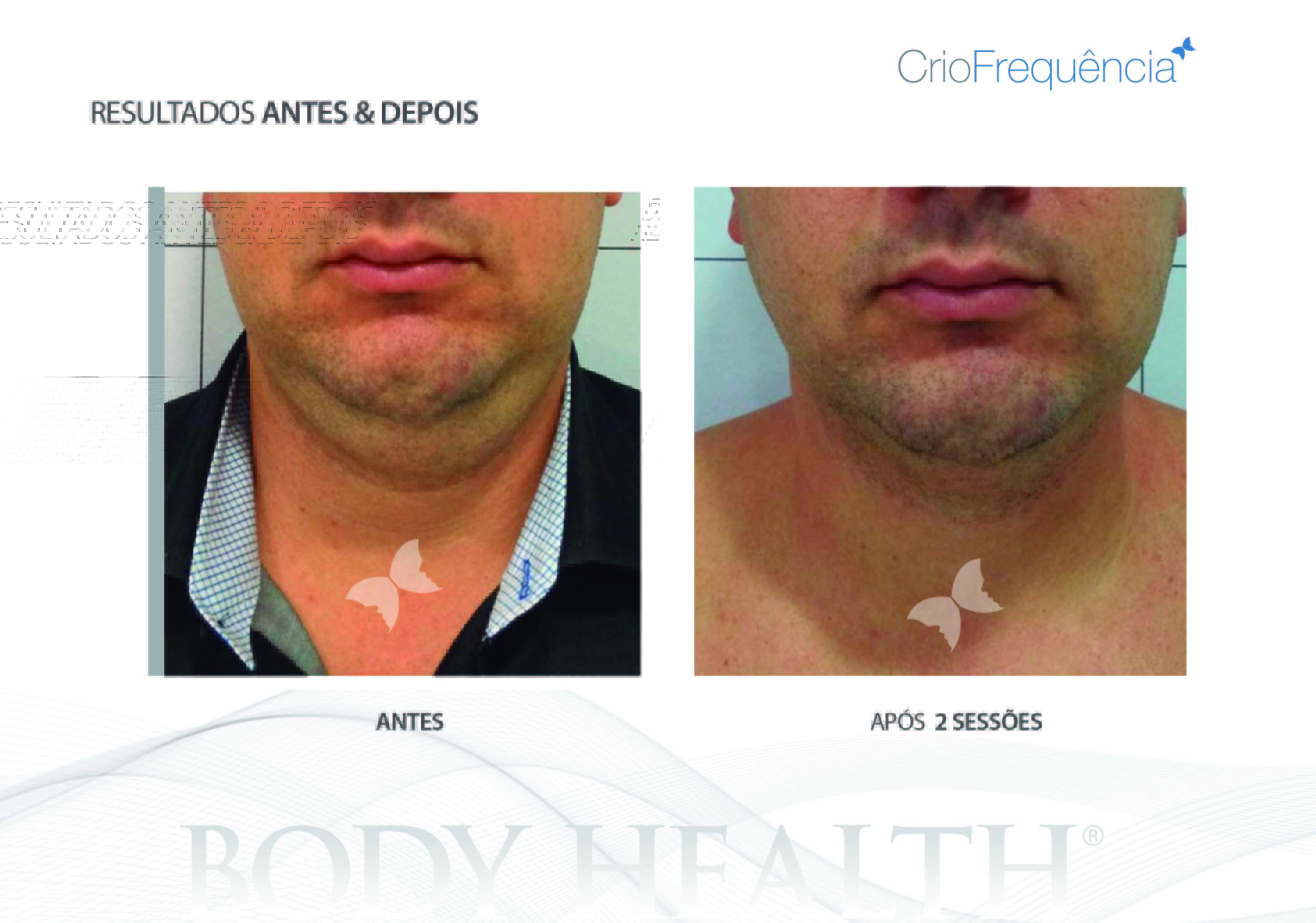 Antes e depois 33 Body Health Brasil