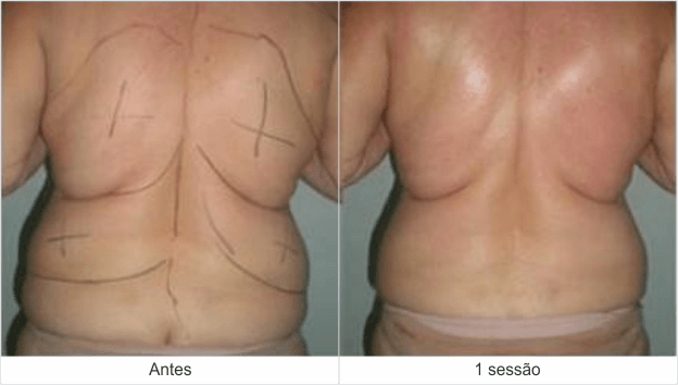 Resultados Dermohealth - antes e depois 4