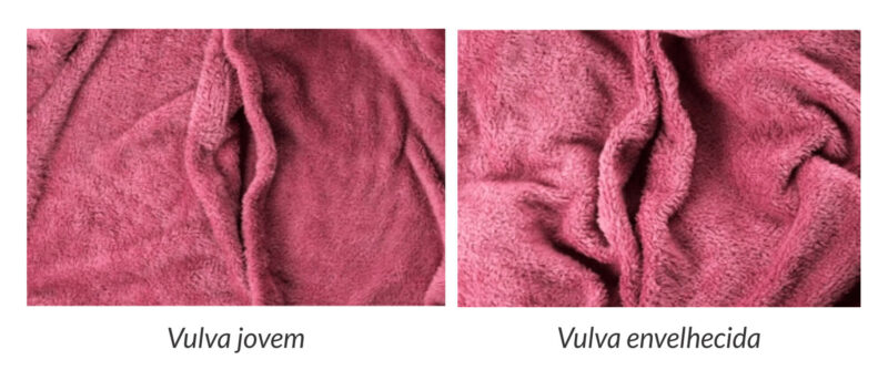 Simulação do envelhecimento vulvar com um tecido enrrugado.