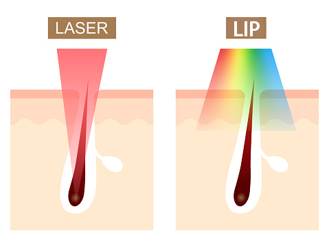 Diferença-da-luz-pulsada-para-o-laser