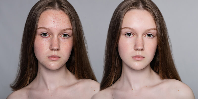 Fotos de antes e depois de mulher em tratamento estético facial.