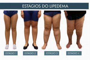 Quatro mulheres em pé mostrando os estágios do lipedema nas pernas, do estágio 1 ao estágio 4, com aumento gradual do volume e irregularidade na pele.