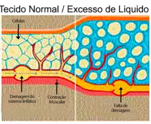 ilustração mostrando o acúmulo de líquido entre as células