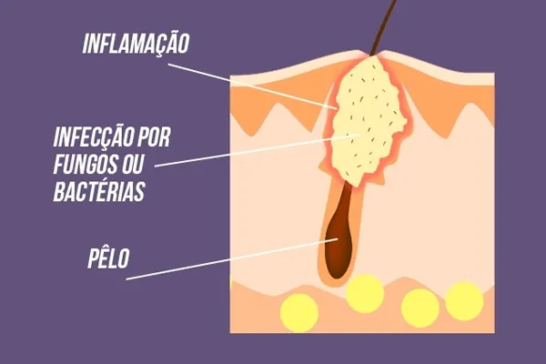 ilustração demonstrando a foliculite